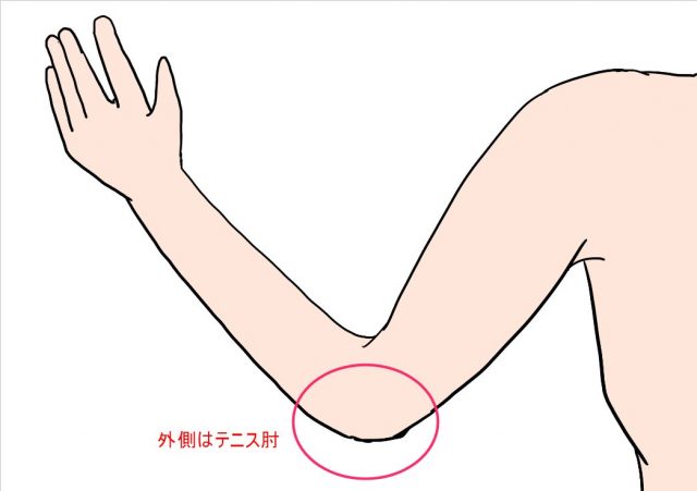 テニス肘