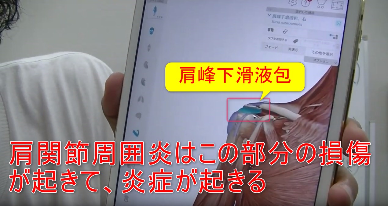 54-05_肩関節周囲炎はこの部分の損傷が起きて、炎症が起きる