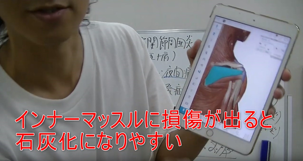 54-14_インナーマッスルに損傷が出ると石灰化になりやすい