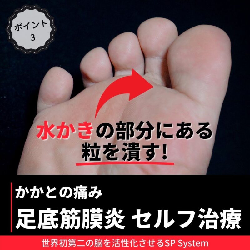 足底筋膜炎を改善する方法は？ポイント③：水かきにある粒を潰す